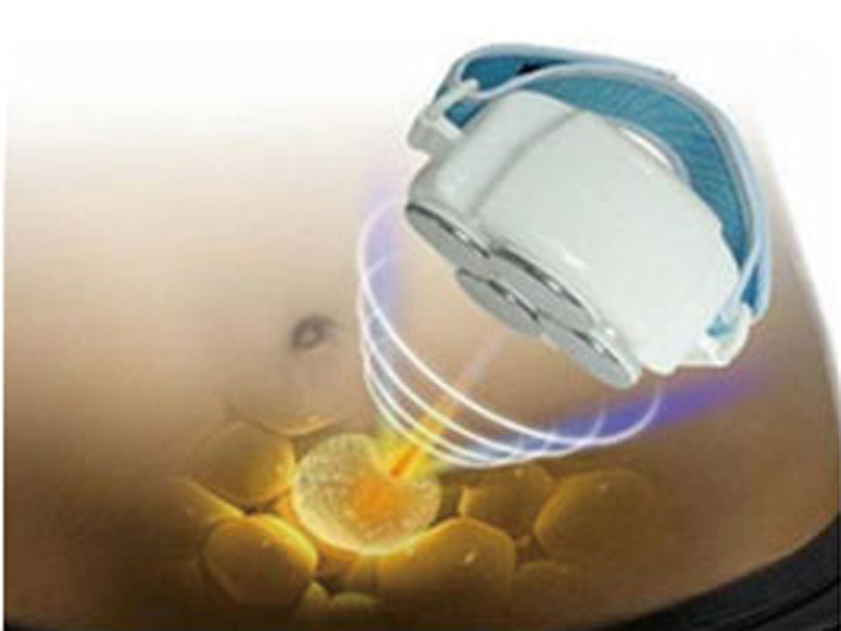 脂肪冷却キャビテーション