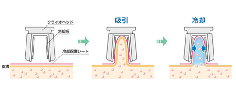 脂肪冷却キャビテーション