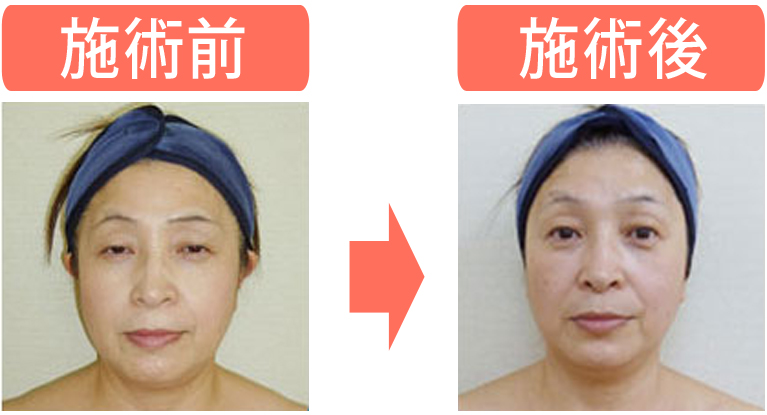 本格フェイスリンパコース