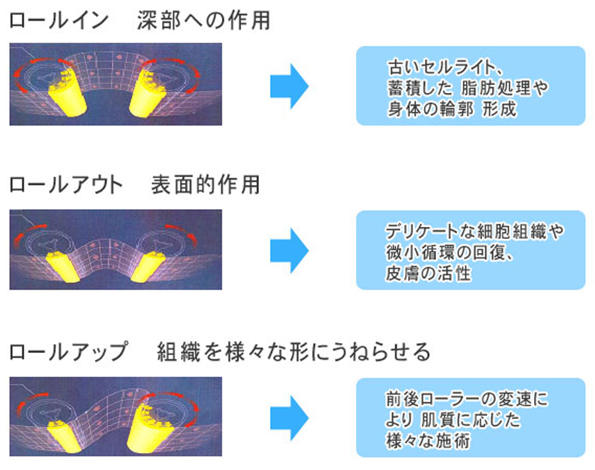 脂肪冷却キャビテーション